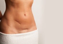 Trattamento delle cicatrici con Tecar terapia