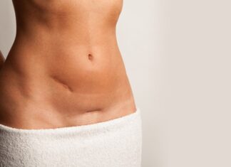 Trattamento delle cicatrici con Tecar terapia